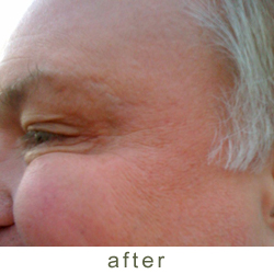 botox after photo