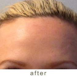 botox after 2 photo