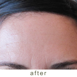 botox after 3 photo