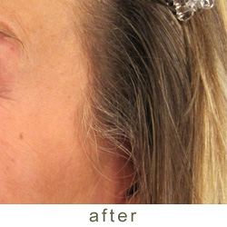 botox after 4 photo