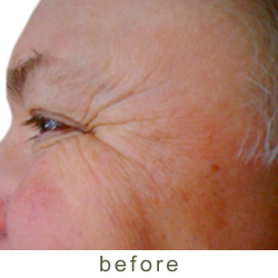botox before