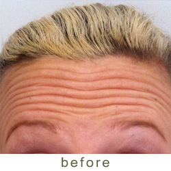 botox before 2