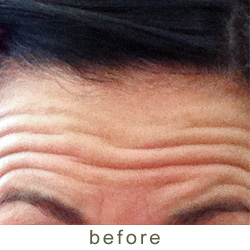 botox before 3
