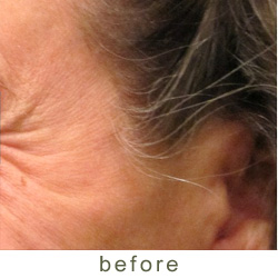 botox before 4