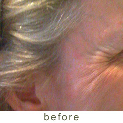 dysport before 