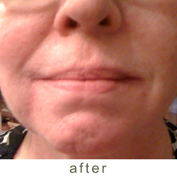 filler after photo