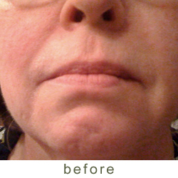 filler before